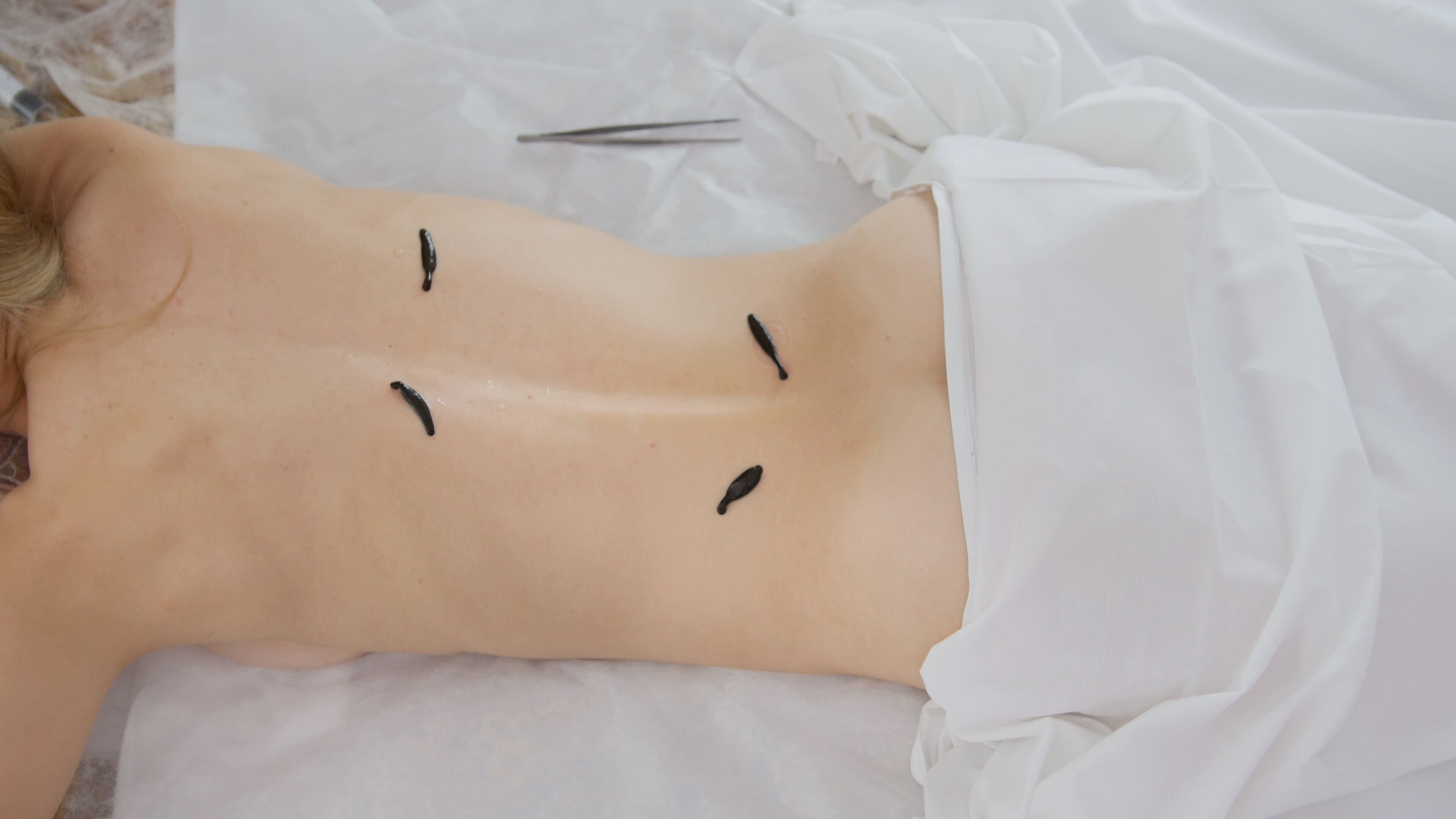 Università E Campus Master Di Primo Livello Hirudoterapia